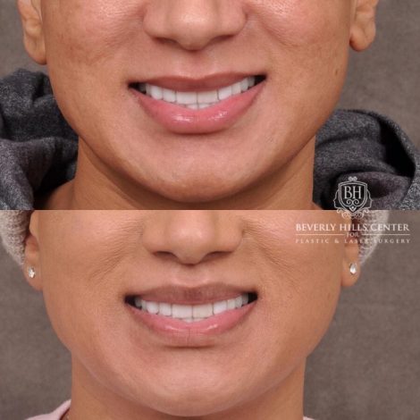 Beverly Hills Center Male Patient Before and After Modified Upper Lip Lift Deep Plane Release