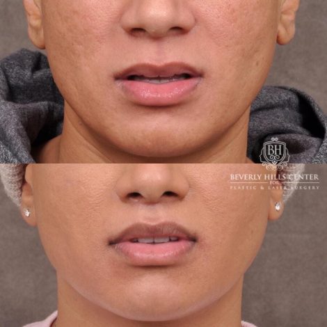 Beverly Hills Center Male Patient Before and After Modified Upper Lip Lift Deep Plane Release