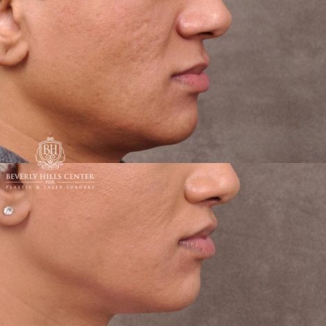 Beverly Hills Center Male Patient Before and After Modified Upper Lip Lift Deep Plane Release