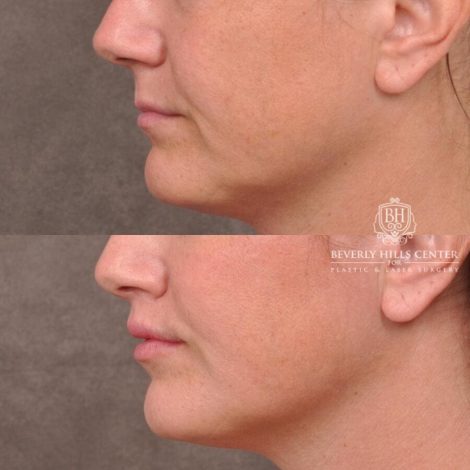 Beverly Hills Center Male Patient Before and After Lip Lift