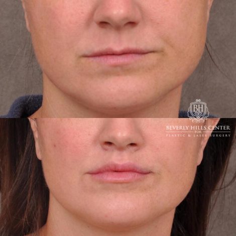Beverly Hills Center Male Patient Before and After Lip Lift