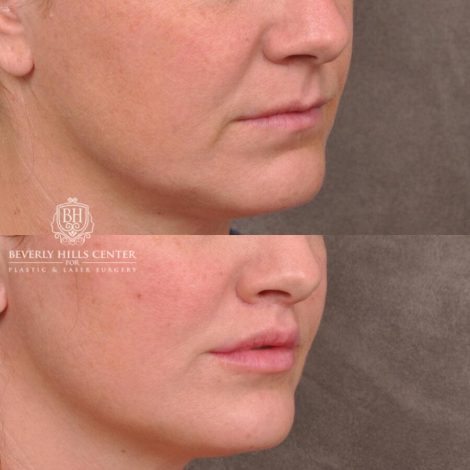 Beverly Hills Center Male Patient Before and After Lip Lift