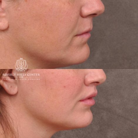 Beverly Hills Center Male Patient Before and After Lip Lift