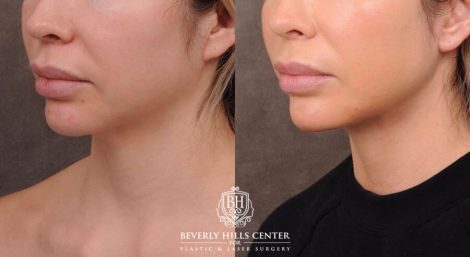 Beverly Hills Center Male Patient Before and After Weekend Necklift