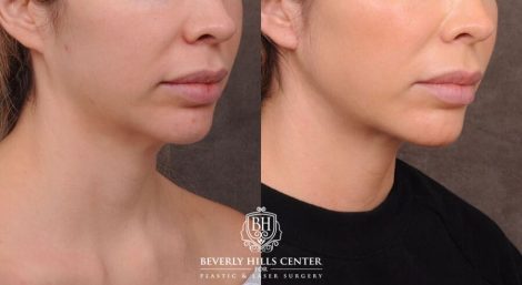 Beverly Hills Center Male Patient Before and After Weekend Necklift