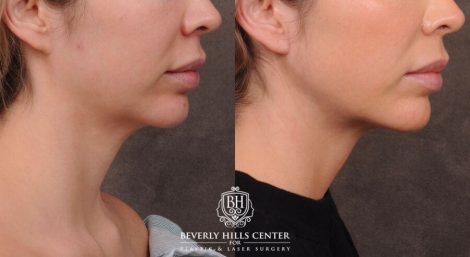 Beverly Hills Center Male Patient Before and After Weekend Necklift