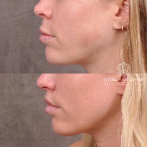 Beverly Hills Center Female Patient Before and After Lip Filler