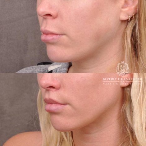 Beverly Hills Center Female Patient Before and After Lip Filler