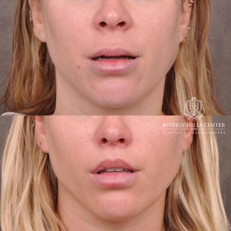 Beverly Hills Center Female Patient Before and After Lip Filler