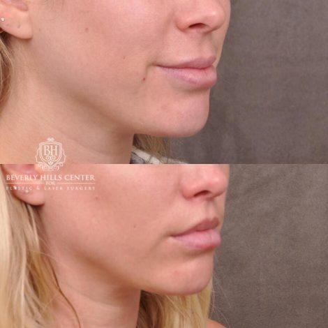 Beverly Hills Center Female Patient Before and After Lip Filler