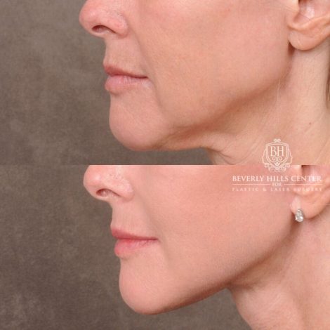 Beverly Hills Center Female Patient Before and After Auralyft, Browlift, CUPID LIFT® Corner Lift Type 2, Upper Bleph with Fat Repo/Graft & SMAS Rejuvenation via PHAT