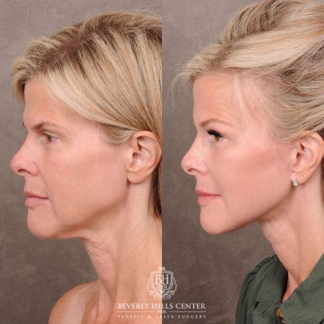 Beverly Hills Center Female Patient Before and After Auralyft, Browlift, CUPID LIFT® Corner Lift Type 2, Upper Bleph with Fat Repo/Graft & SMAS Rejuvenation via PHAT