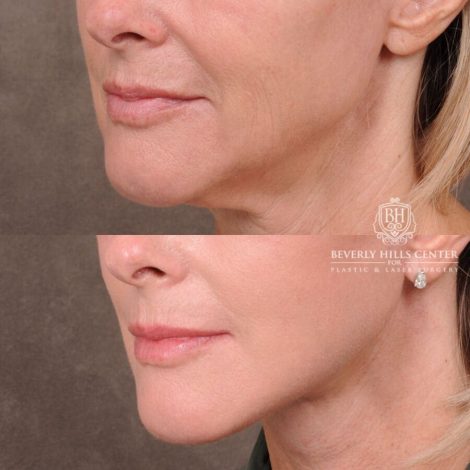 Beverly Hills Center Female Patient Before and After Auralyft, Browlift, CUPID LIFT® Corner Lift Type 2, Upper Bleph with Fat Repo/Graft & SMAS Rejuvenation via PHAT