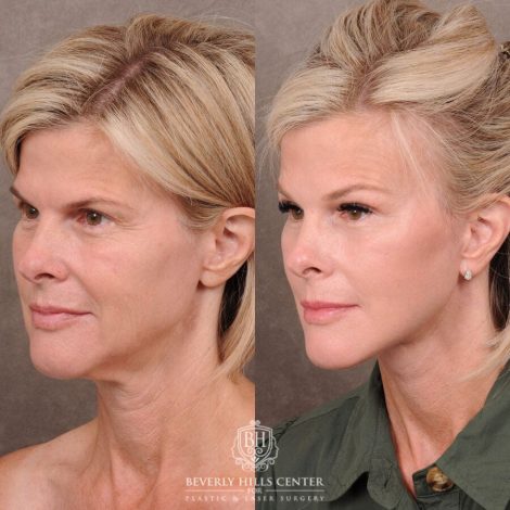 Beverly Hills Center Female Patient Before and After Auralyft, Browlift, CUPID LIFT® Corner Lift Type 2, Upper Bleph with Fat Repo/Graft & SMAS Rejuvenation via PHAT