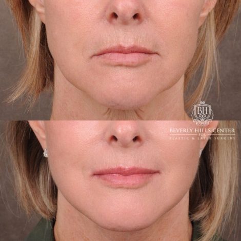 Beverly Hills Center Female Patient Before and After Auralyft, Browlift, CUPID LIFT® Corner Lift Type 2, Upper Bleph with Fat Repo/Graft & SMAS Rejuvenation via PHAT