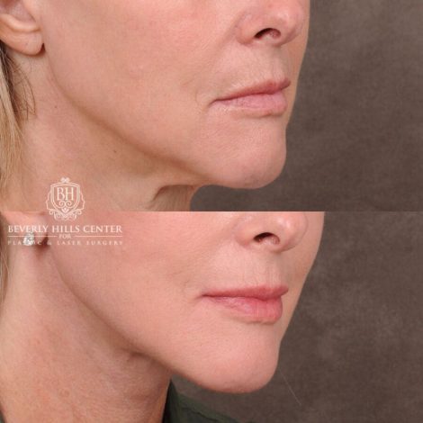 Beverly Hills Center Female Patient Before and After Auralyft, Browlift, CUPID LIFT® Corner Lift Type 2, Upper Bleph with Fat Repo/Graft & SMAS Rejuvenation via PHAT