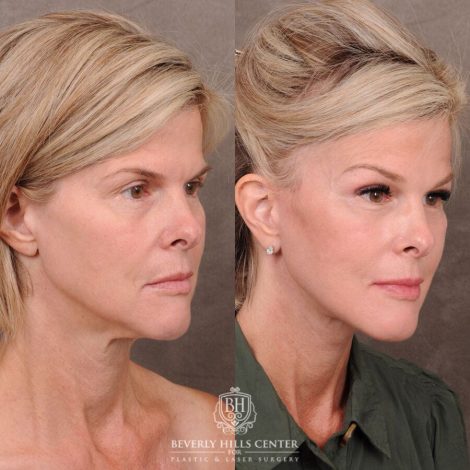 Beverly Hills Center Female Patient Before and After Auralyft, Browlift, CUPID LIFT® Corner Lift Type 2, Upper Bleph with Fat Repo/Graft & SMAS Rejuvenation via PHAT
