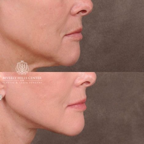 Beverly Hills Center Female Patient Before and After Auralyft, Browlift, CUPID LIFT® Corner Lift Type 2, Upper Bleph with Fat Repo/Graft & SMAS Rejuvenation via PHAT