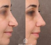 Beverly Hills Center Female Patient Before and After AuraLyft Procedure and Revision Rhinoplasty with Rib and Fascia Grafting