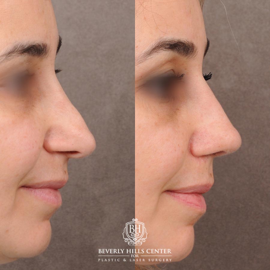 Beverly Hills Center Female Patient Before and After AuraLyft Procedure and Revision Rhinoplasty with Rib and Fascia Grafting