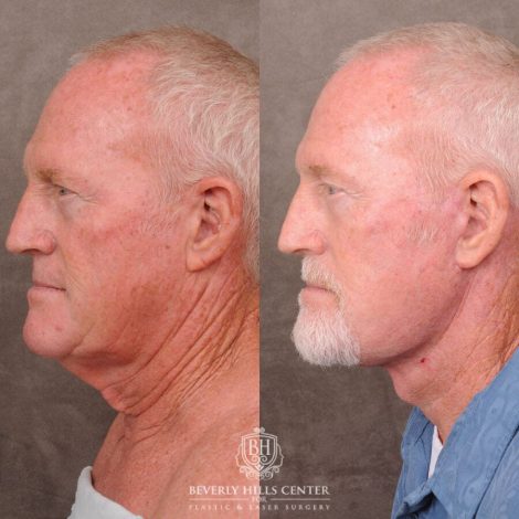 Beverly Hills Center Male Patient Before and After Auralyft