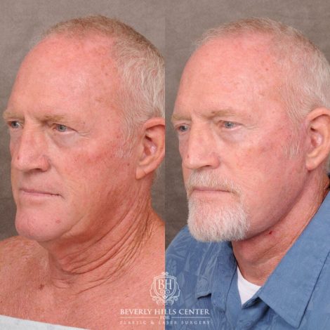Beverly Hills Center Male Patient Before and After Auralyft
