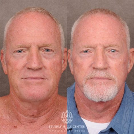 Beverly Hills Center Male Patient Before and After Auralyft