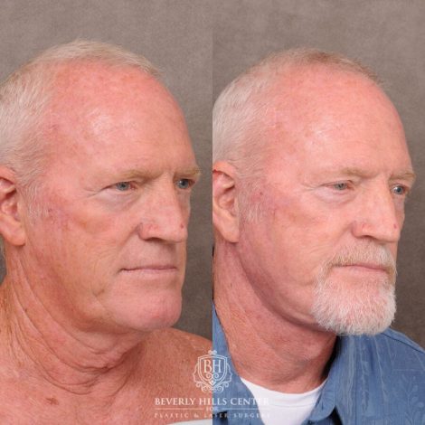 Beverly Hills Center Male Patient Before and After Auralyft