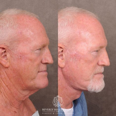 Beverly Hills Center Male Patient Before and After Auralyft