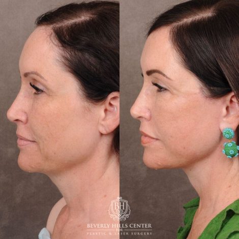 Beverly Hills Center Female Patient Before and After Auralyft