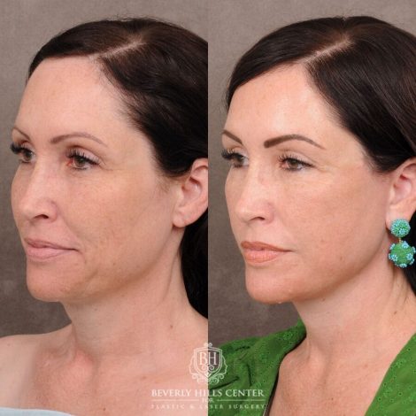 Beverly Hills Center Female Patient Before and After Auralyft