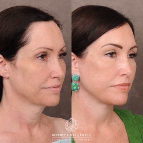 Beverly Hills Center Female Patient Before and After Auralyft