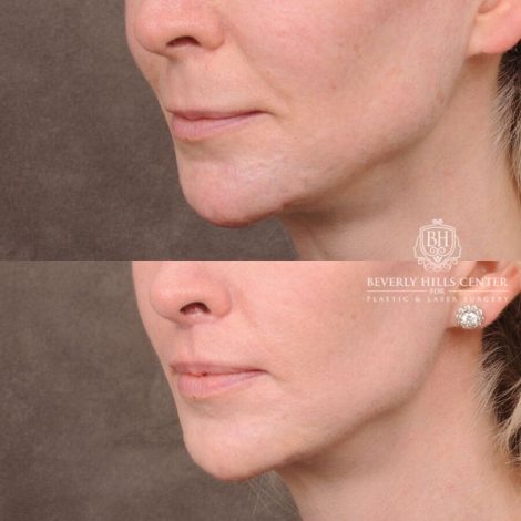 Beverly Hills Center Female Patient Before and After Deep Plane Modified Upper Lip Lift
