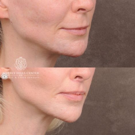 Beverly Hills Center Female Patient Before and After Deep Plane Modified Upper Lip Lift