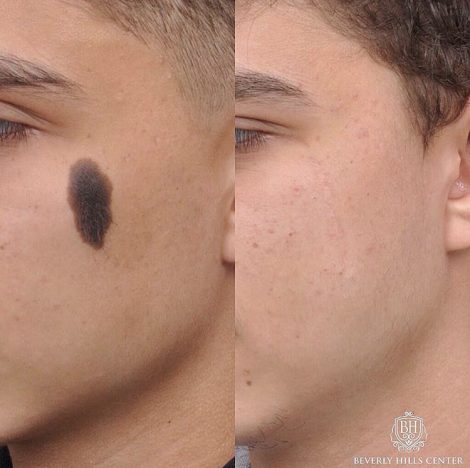 Beverly Hills Center Male Patient Before and After Mole Removal