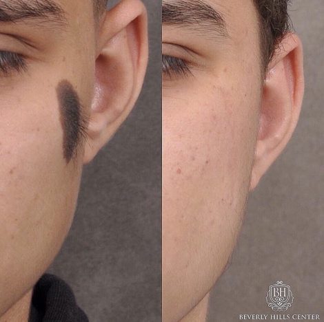 Beverly Hills Center Male Patient Before and After Mole Removal