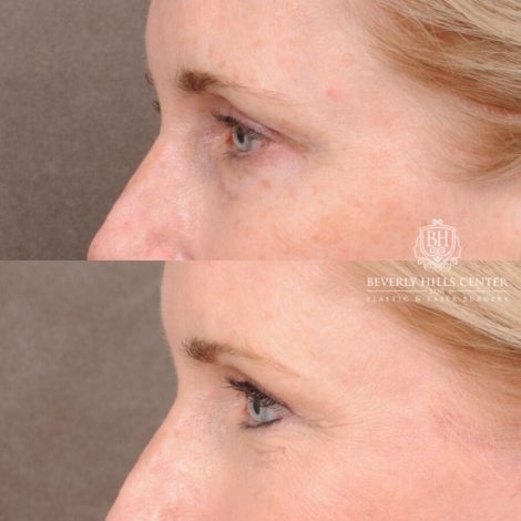 Beverly Hills Center Female Patient Before and After AuraLyft, Browlift, Upper & Lower Blepharoplasty with Fat Graf, and Co2 Eyes/Mouth