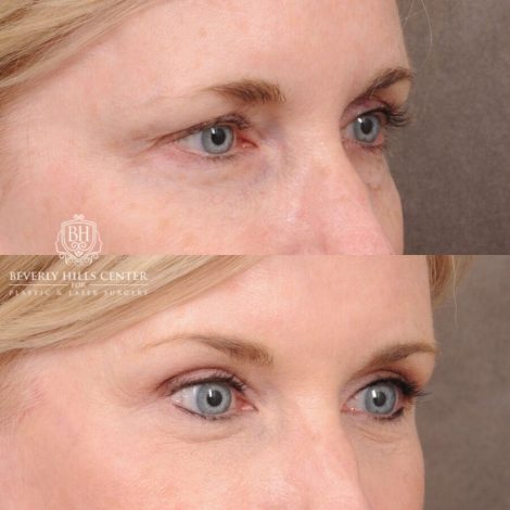 Beverly Hills Center Female Patient Before and After AuraLyft, Browlift, Upper & Lower Blepharoplasty with Fat Graf, and Co2 Eyes/Mouth