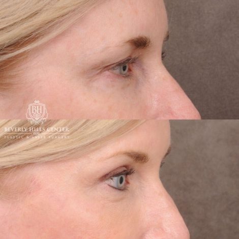Beverly Hills Center Female Patient Before and After AuraLyft, Browlift, Upper & Lower Blepharoplasty with Fat Graf, and Co2 Eyes/Mouth