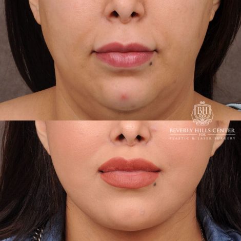 Beverly Hills Center Female Patient Before and After Auralyft, Fat Grafting & Lip Lift