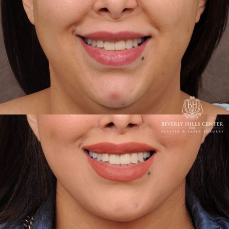 Beverly Hills Center Female Patient Before and After Auralyft, Fat Grafting & Lip Lift