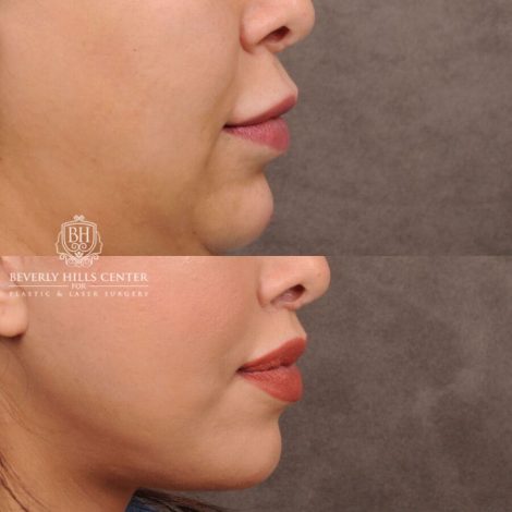 Beverly Hills Center Female Patient Before and After Auralyft, Fat Grafting & Lip Lift