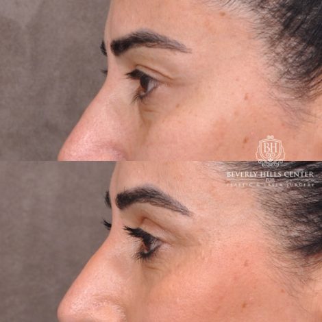 Beverly Hills Center Female Patient Before and After Upper Blepharoplasty
