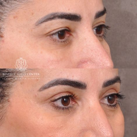 Beverly Hills Center Female Patient Before and After Upper Blepharoplasty