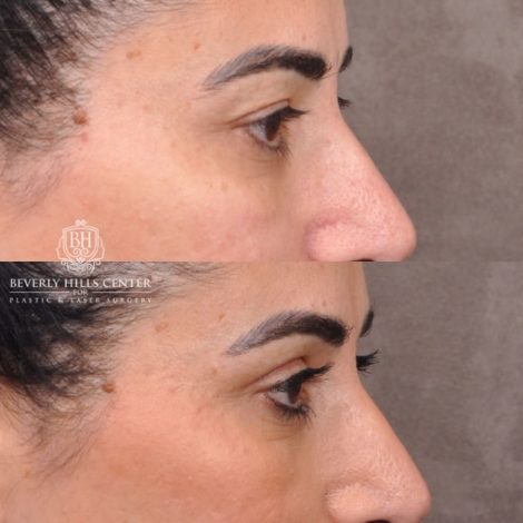 Beverly Hills Center Female Patient Before and After Upper Blepharoplasty