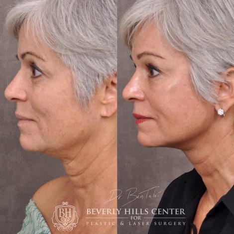 Beverly Hills Center Female Patient Before and After AuraLyft, Brow Lift