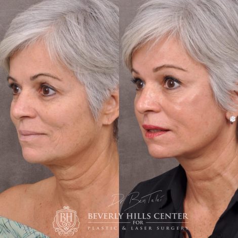 Beverly Hills Center Female Patient Before and After AuraLyft, Brow Lift
