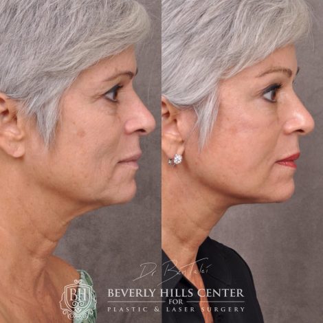 Beverly Hills Center Female Patient Before and After AuraLyft, Brow Lift