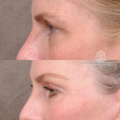 Beverly Hills Center Male Patient Before and After AuraLyft, Brow Lift with TCA Peel and Lip Lift