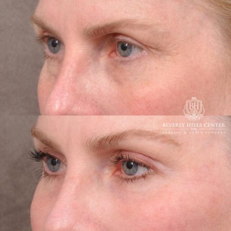 Beverly Hills Center Male Patient Before and After AuraLyft, Brow Lift with TCA Peel and Lip Lift